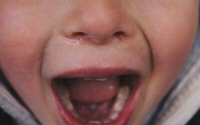 Understanding Bruxism in Kids: Causes and Management Strategies