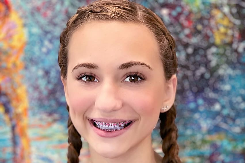 A young girl smiling while exposing her braces Pediatric Orthodontics - Girl with braces