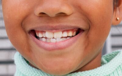 Preventing Dental Problems with Sealants: Are They Right for Your Child?